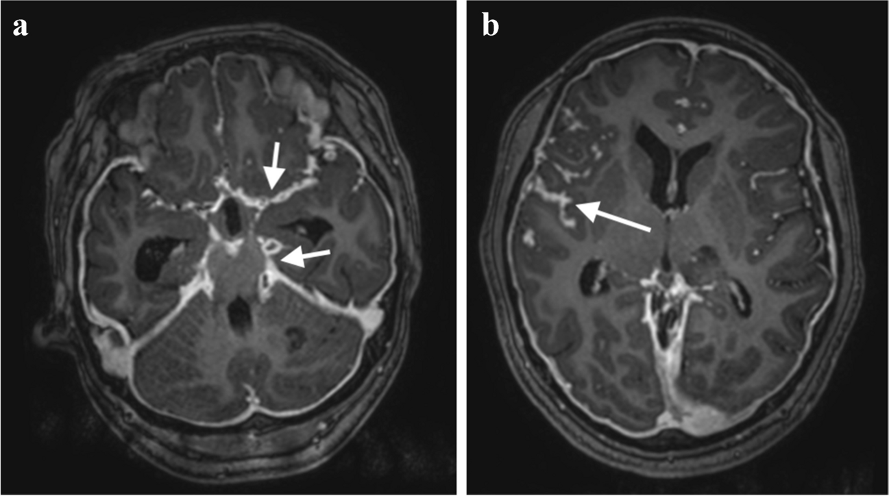 Intracranial manifestations of central nervous system tuberculosis in children