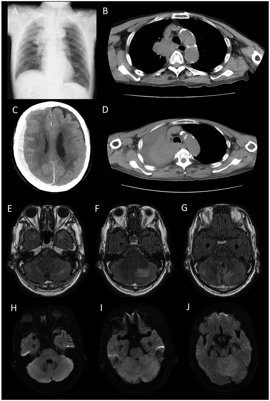 Case report: An autopsy report of patient with metastatic brain tumor and carcinomatous meningitis mimicking paraneoplastic neurological syndrome