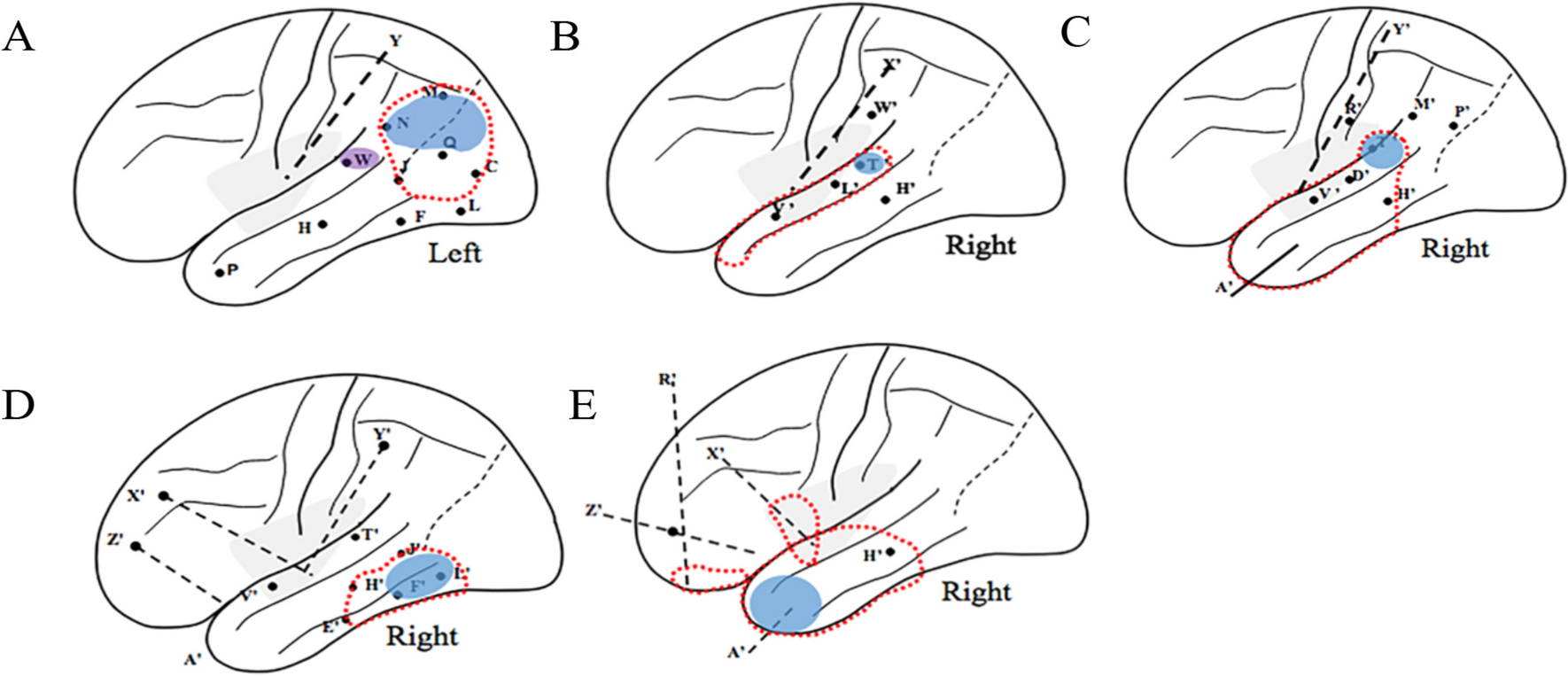Surgical treatment of long-term epilepsy-associated tumors guided by stereoelectroencephalography