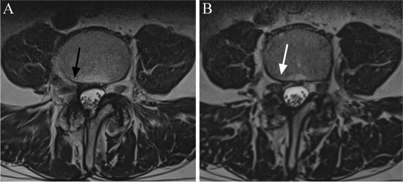 Diagnostic utility of 3D MRI sequences in the assessment of central, recess and foraminal stenoses of the spine: a systematic review