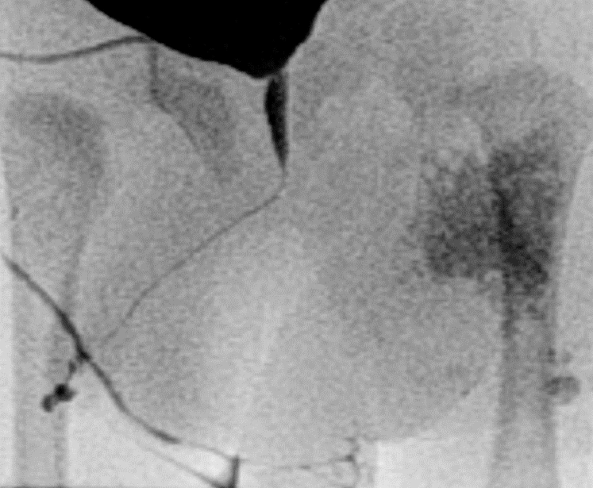 A new spectrum of neonatal urethral pathologies in the era of early vesicoamniotic shunting?