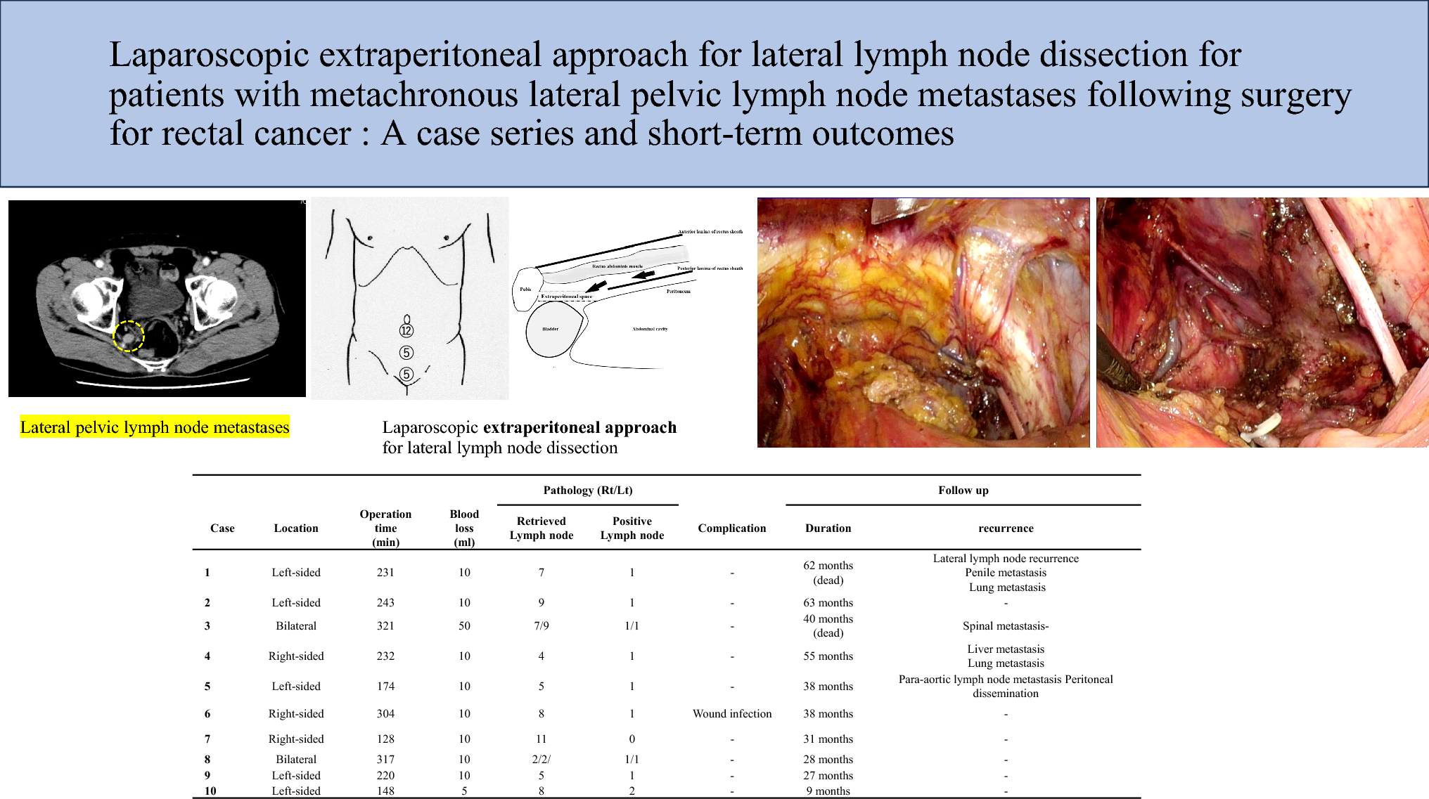 Laparoscopic extraperitoneal approach for lateral lymph node dissection for patients with metachronous lateral pelvic lymph node metastases following surgery for rectal cancer: a case series and short-term outcomes
