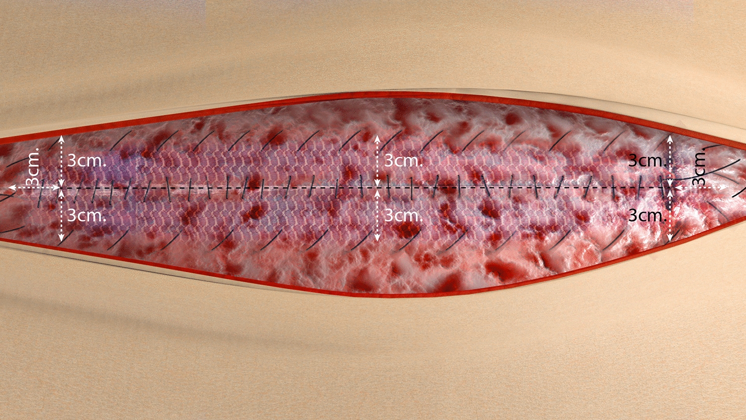 The MESH-RTL Project for prevention of abdominal wound dehiscence (AWD) in high-risk patients: noninferiority, randomized controlled trial