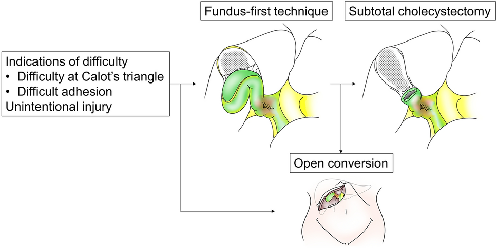 Utilization of the modified Kama scoring system for predicting bail-out cholecystectomy: a valuable tool in the era of rising laparoscopic surgery prevalence