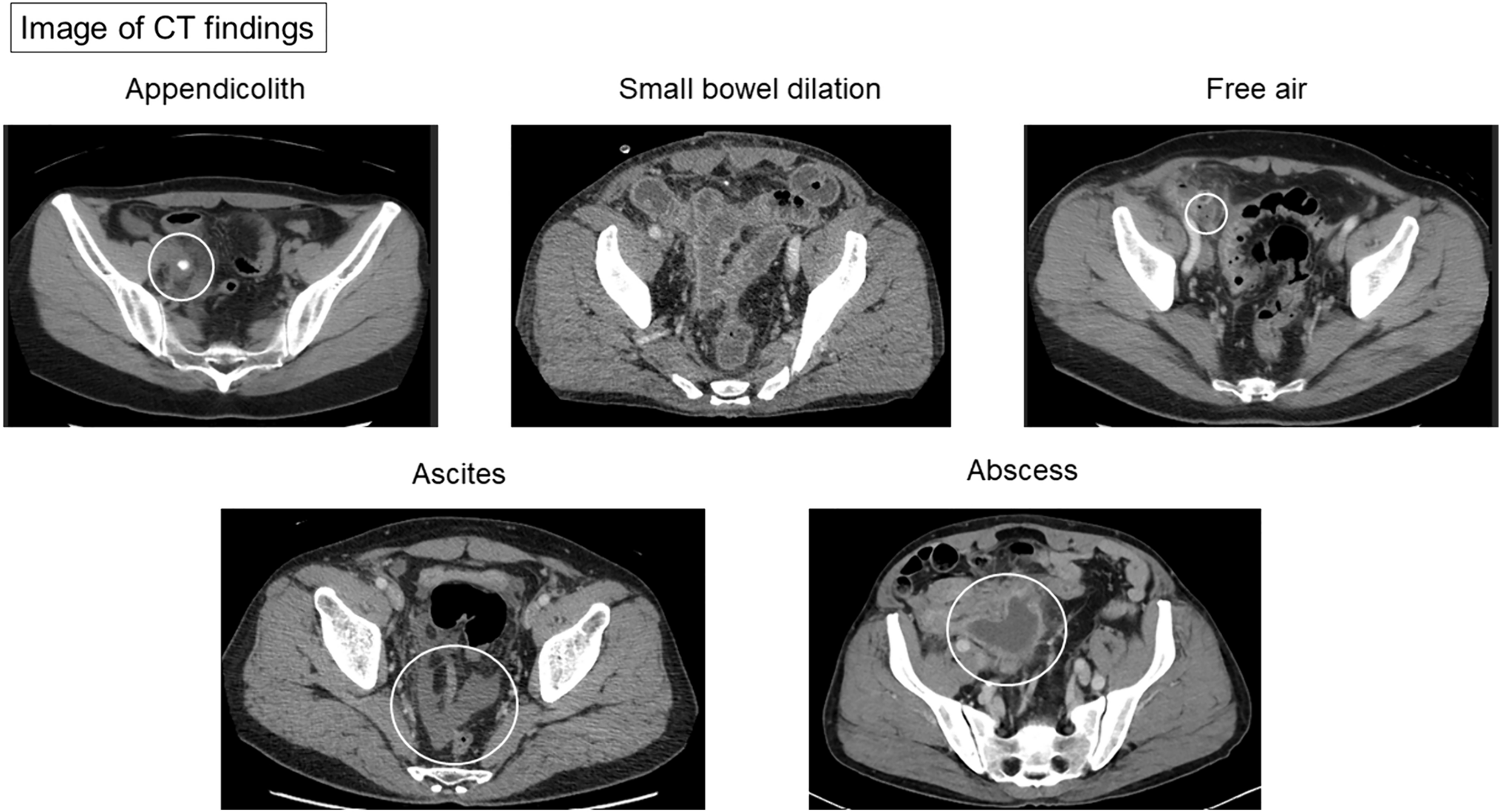 The benefits of interval appendectomy and risk factors for nonoperative management failure in the therapeutic strategy for complicated appendicitis
