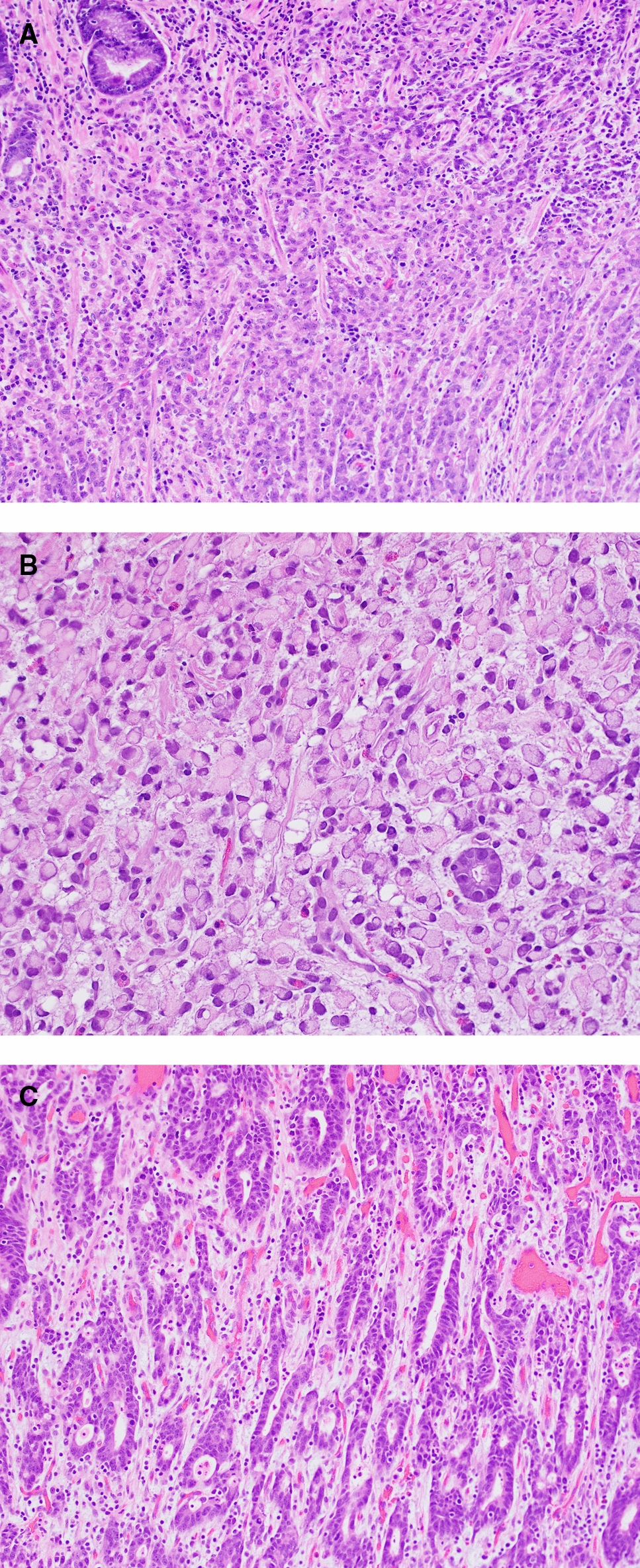Diffuse Gastric Cancer: A Comprehensive Review of Molecular Features and Emerging Therapeutics