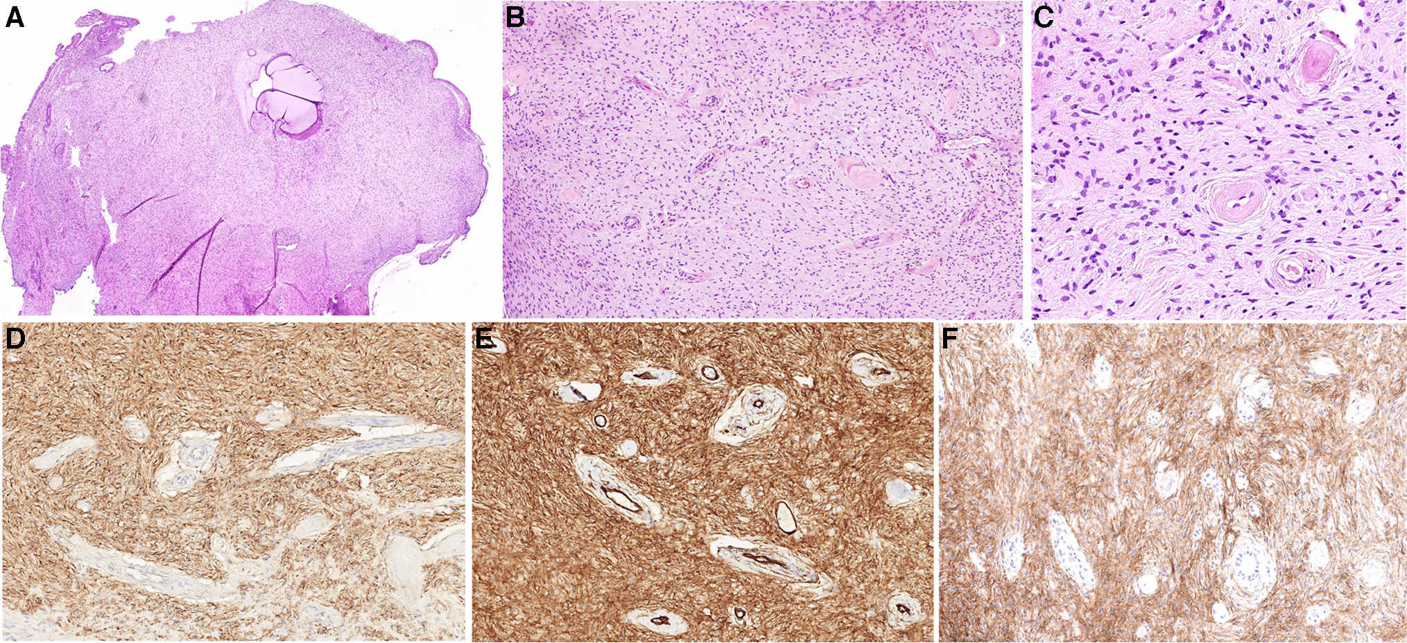 S100 and CD34 positive spindle cell tumors of the uterine cervix with EGFR mutation: a hitherto unrecognized neoplasm phenotypically and epigenetically overlapping with “NTRK-rearranged spindle cell neoplasms” of the uterus
