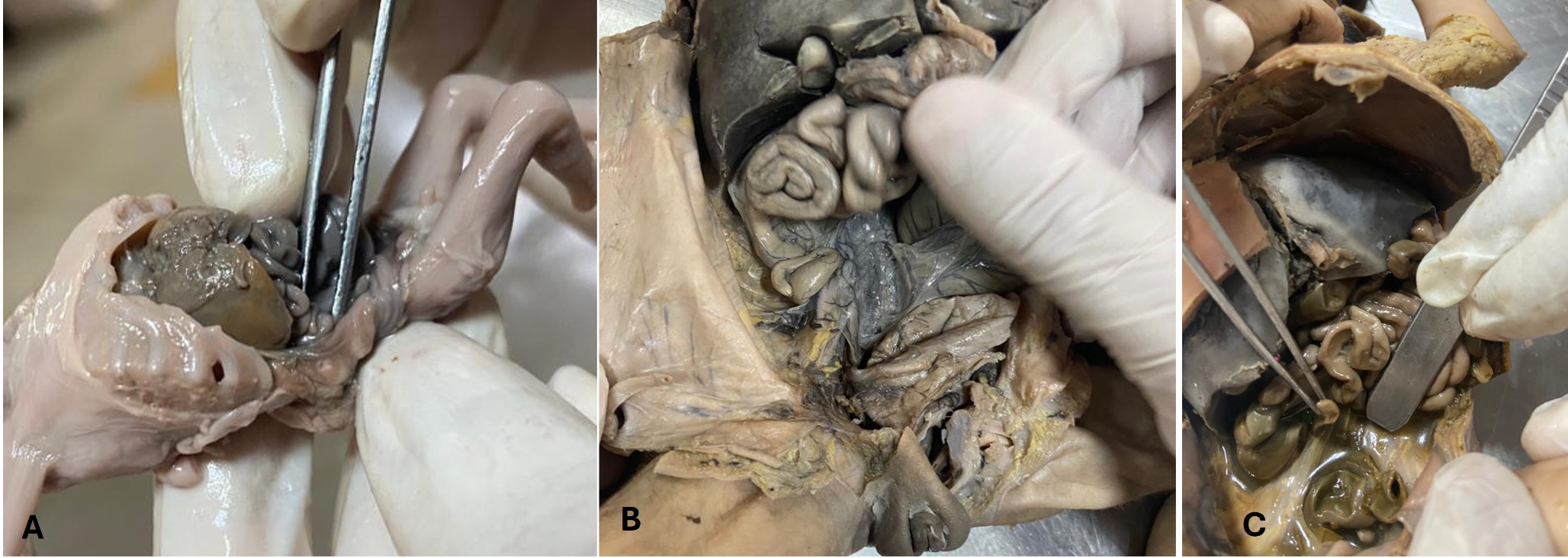 Histomorphometric and developmental analysis of human fetal caecum and appendix with its embryological significance