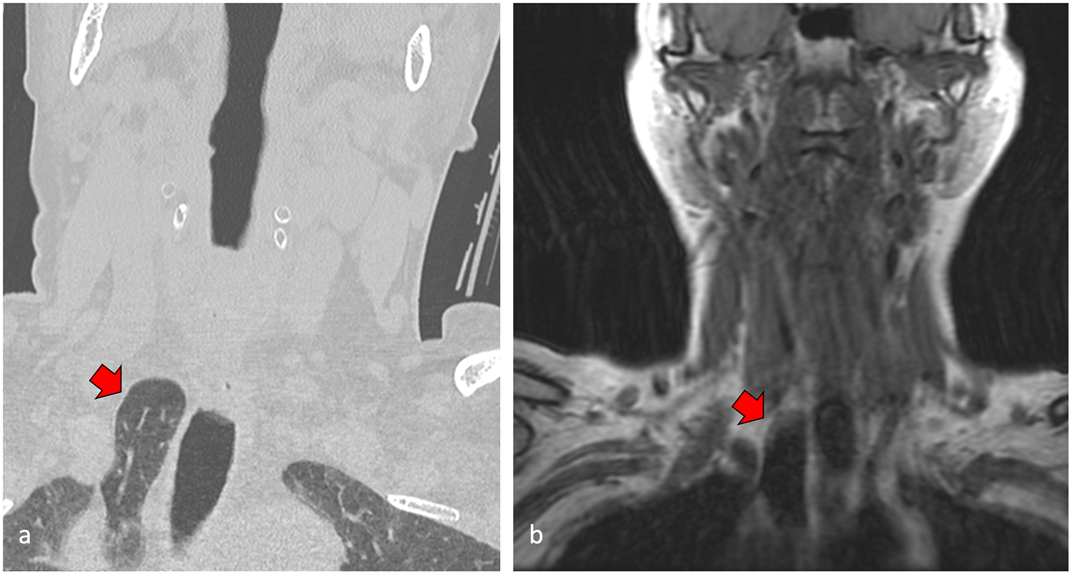 Cervical lung herniation of the azygous lobe: a case report and literature review