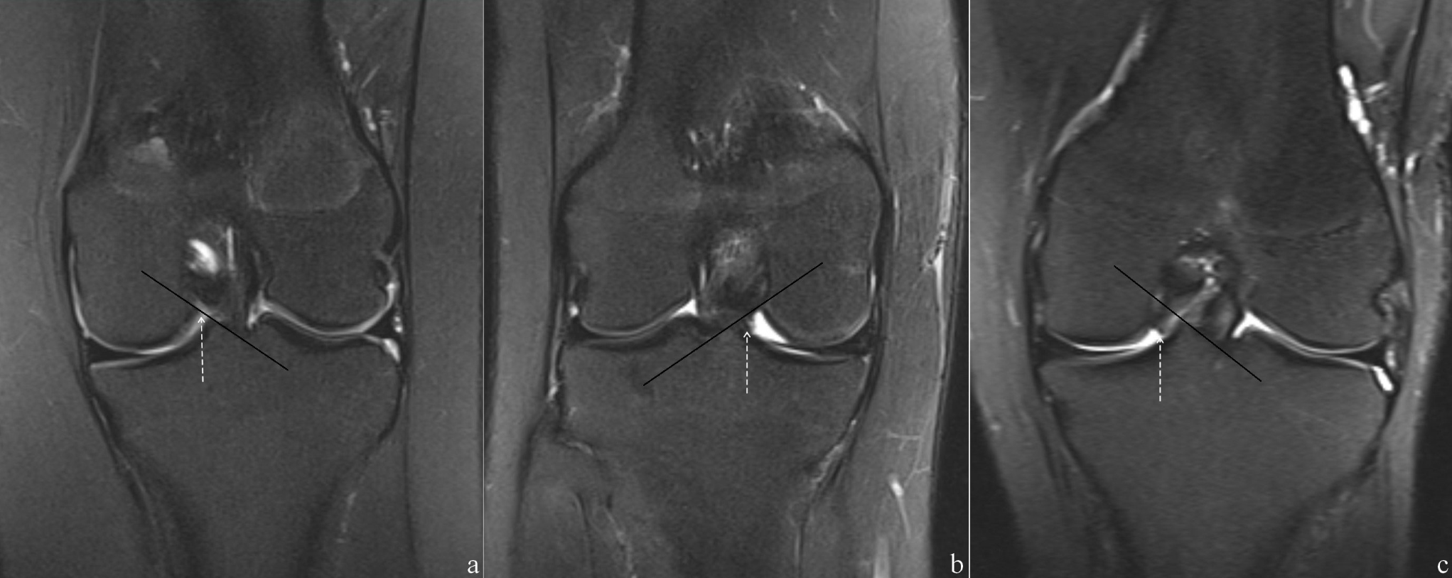 Anatomical variants of the medial synovial fold of the posterior cruciate ligament: morphological classification based on magnetic resonance imaging of the knee