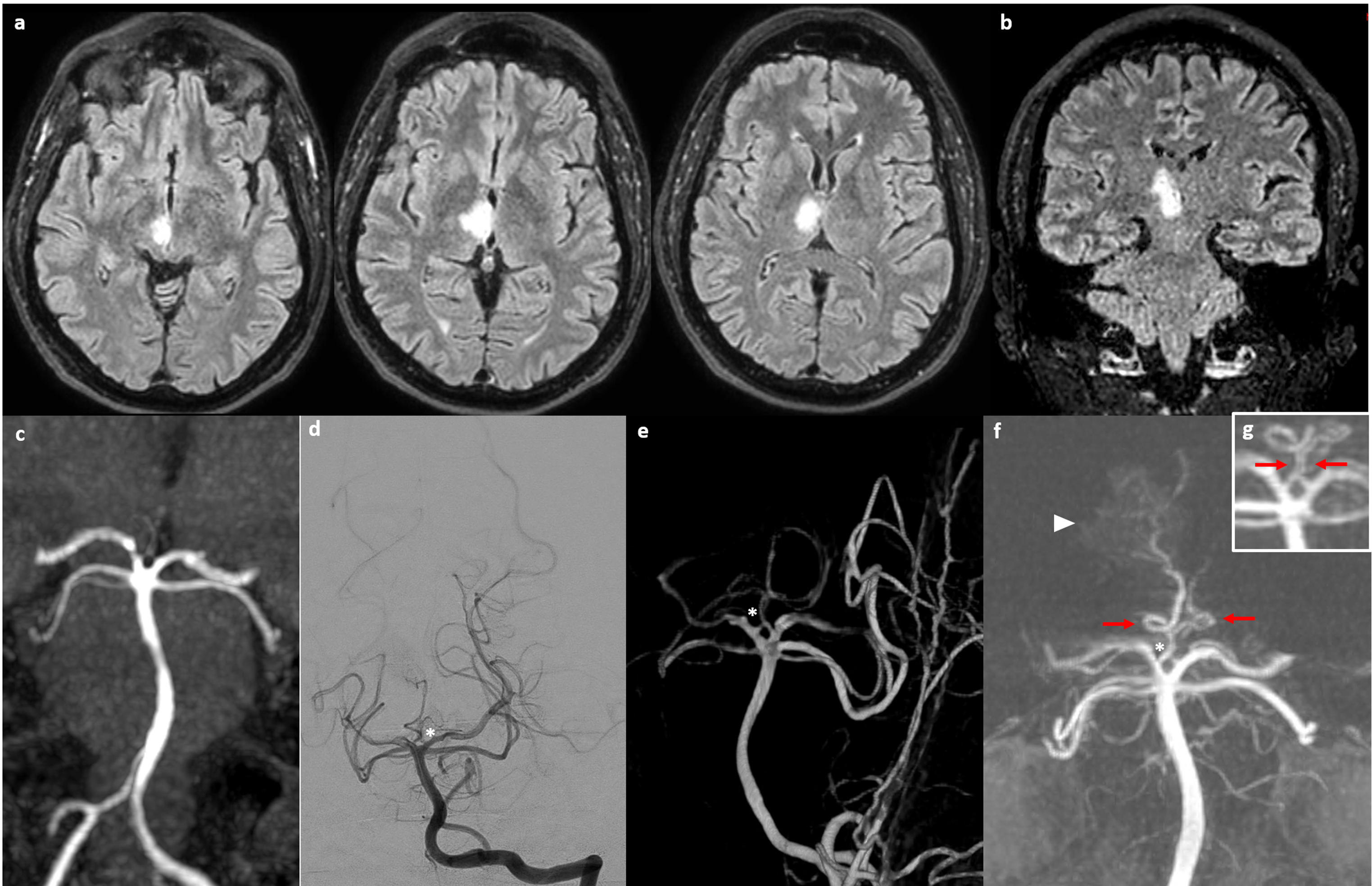 Type III Percheron’s variant in thalamic-mesencephalic infarction: the unexpected anastomosis
