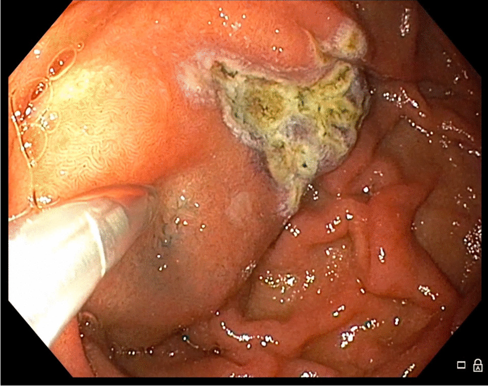Endoscopic duodenal mucosal ablation via spray coagulation technique for duodenal mucosal resurfacing in patients with type 2 diabetes mellitus (with video)