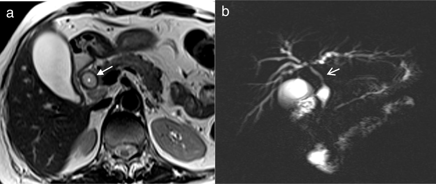 A typical case of IgG4 related sclerosing cholangitis