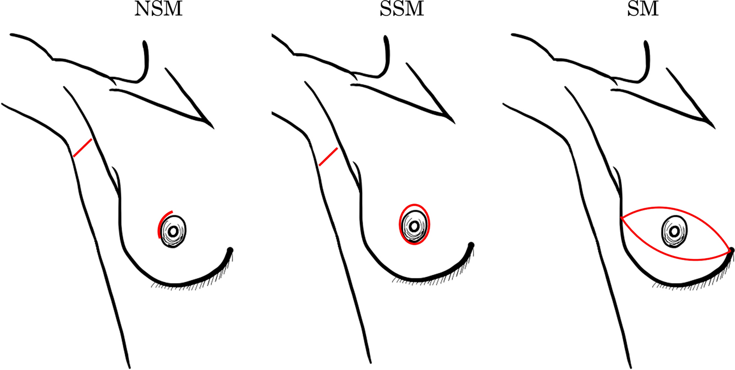 Comparison of locoregional recurrence risk among nipple-sparing mastectomy, skin-sparing mastectomy, and simple mastectomy in patients with ductal carcinoma in situ: a single-center study