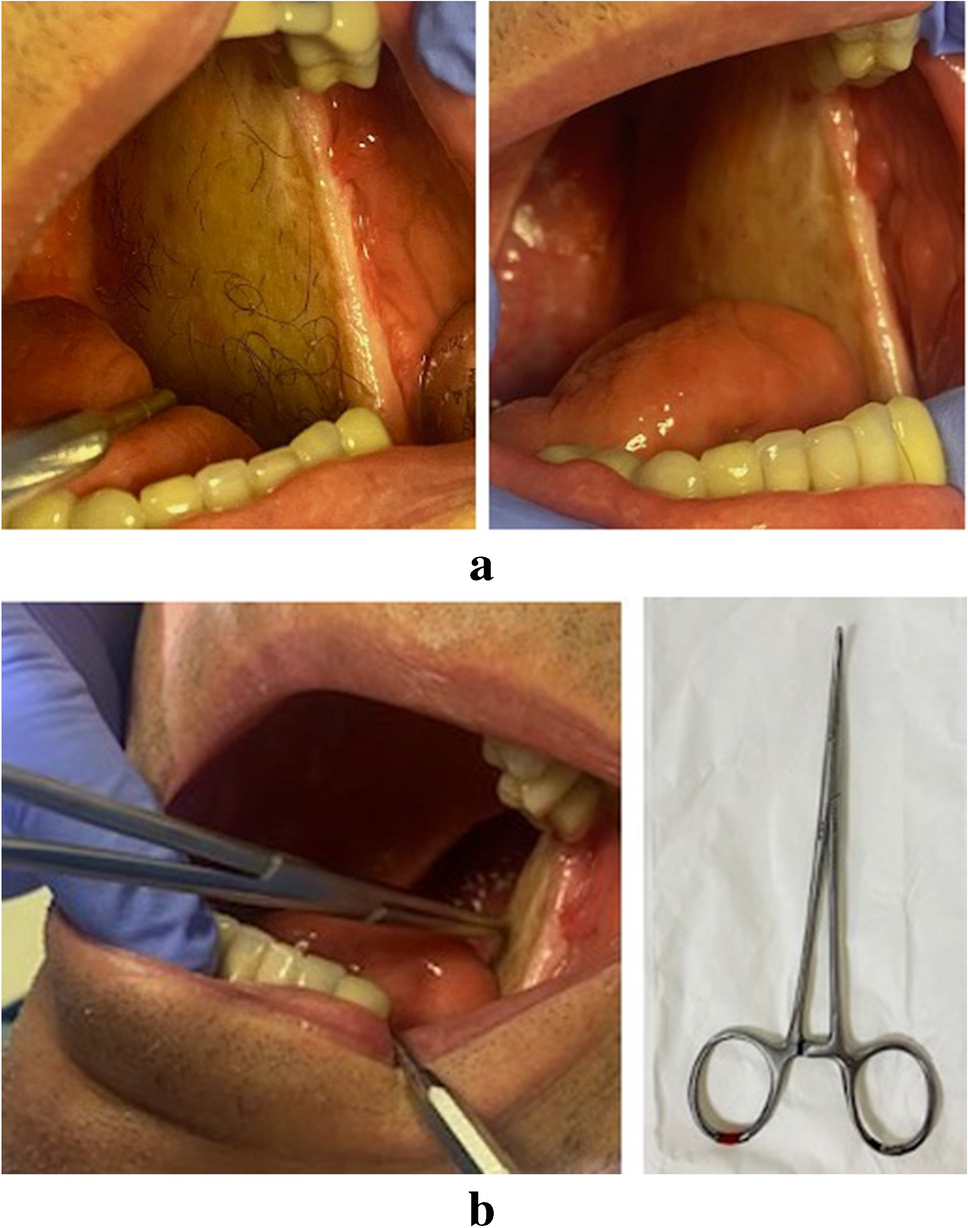 Manual Hair Removal for Intraoral Flaps: a Simple Practice for Professional Education and Patient Cancer Care