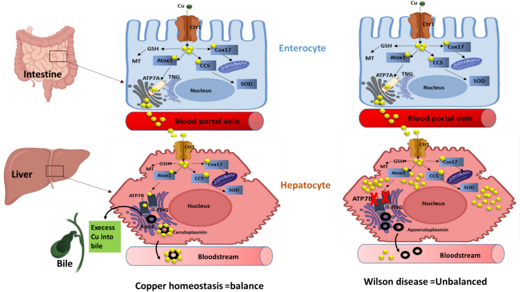 Wilson Disease: Diagnostic Challenges and Differential Diagnoses