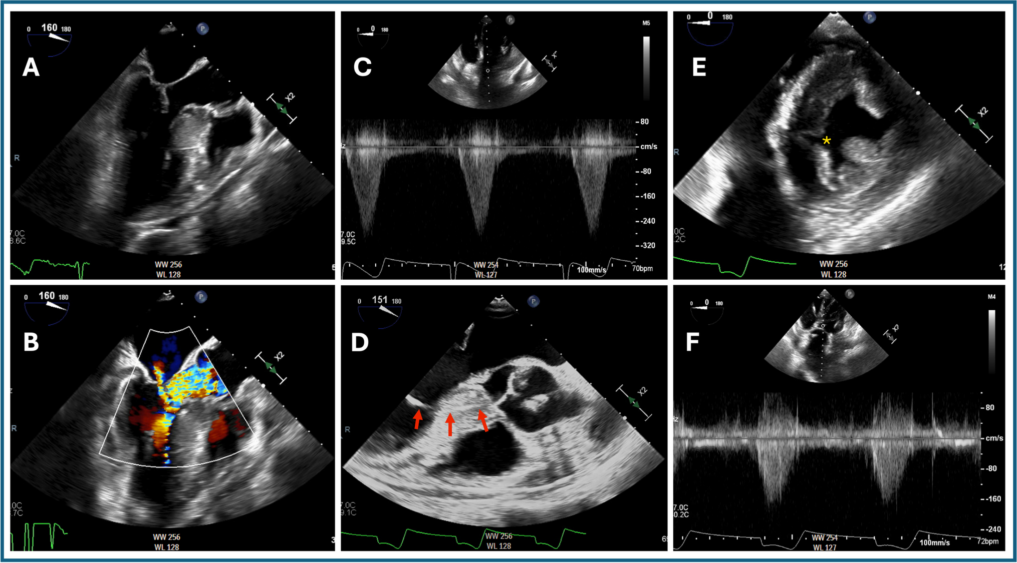 Transcatheter Myotomy for Hypertrophic Obstructive Cardiomyopathy
