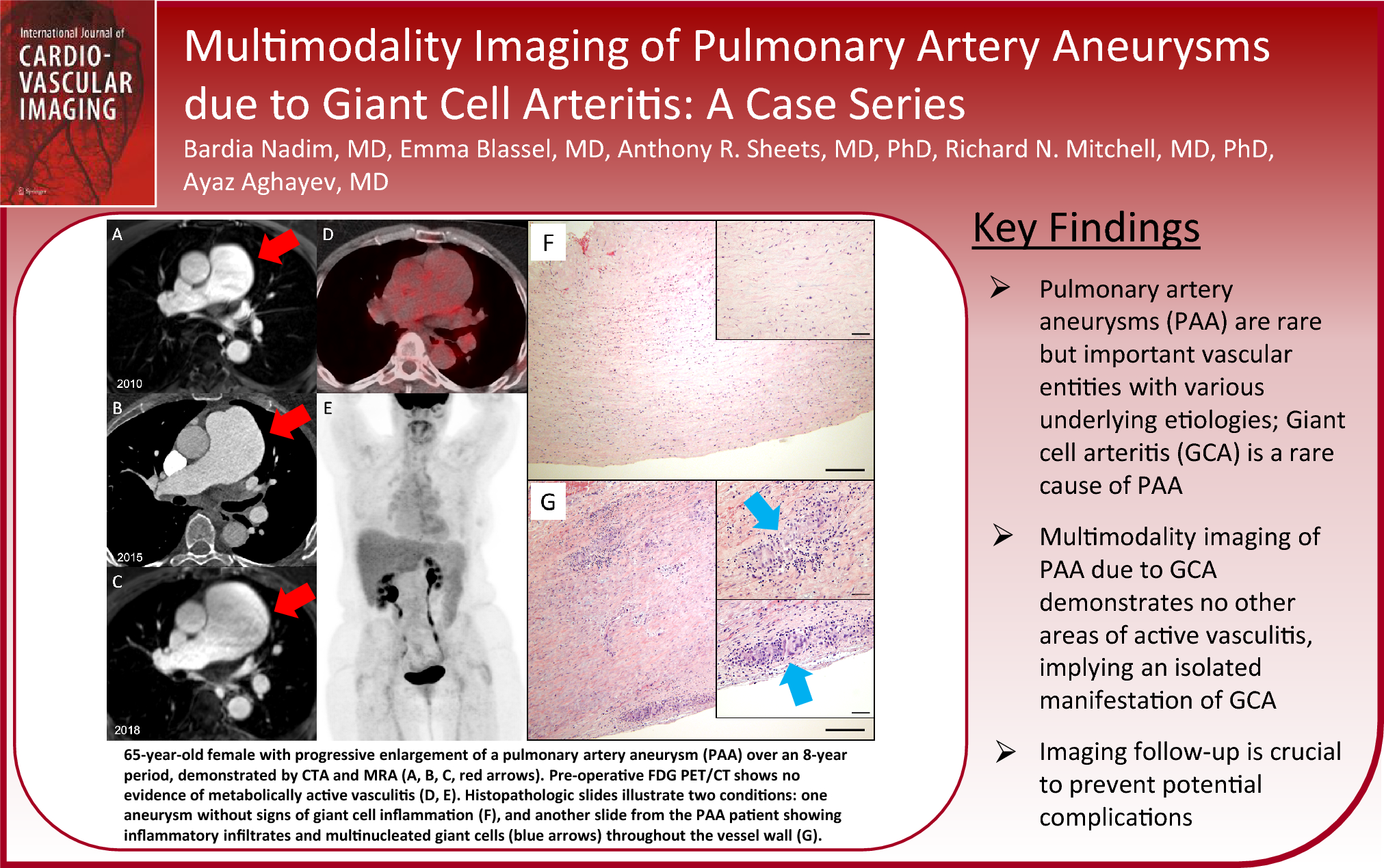 Multimodality imaging of pulmonary artery aneurysms due to giant cell arteritis: a case series