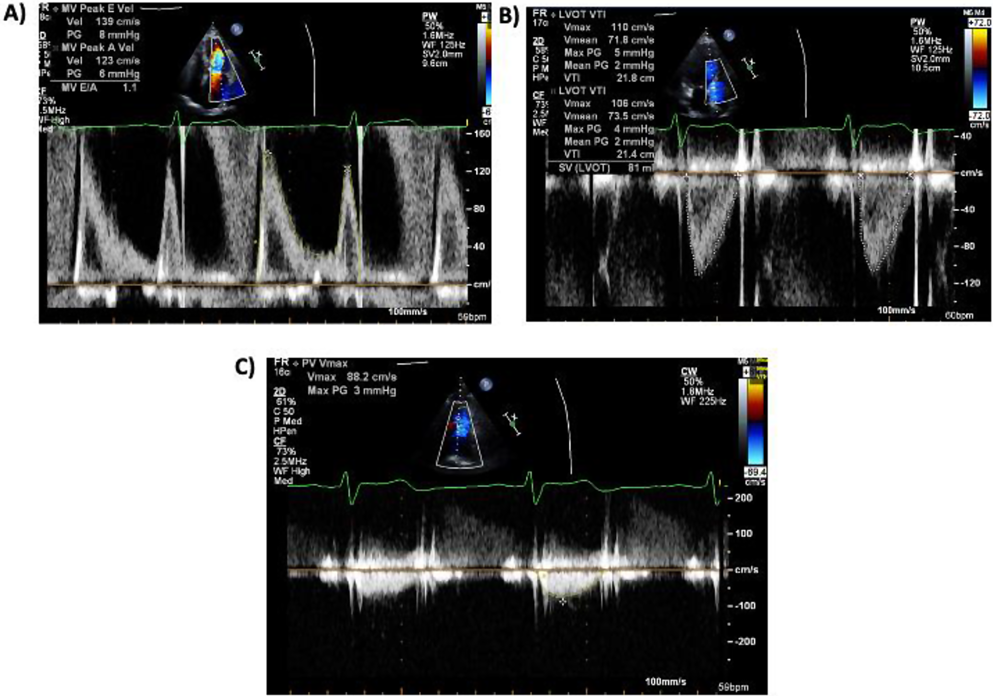 The mitral to aortic/pulmonary velocity-time integral ratio is a simple, feasible and accurate discriminator for echocardiographic evaluation of severe isolated mitral regurgitation