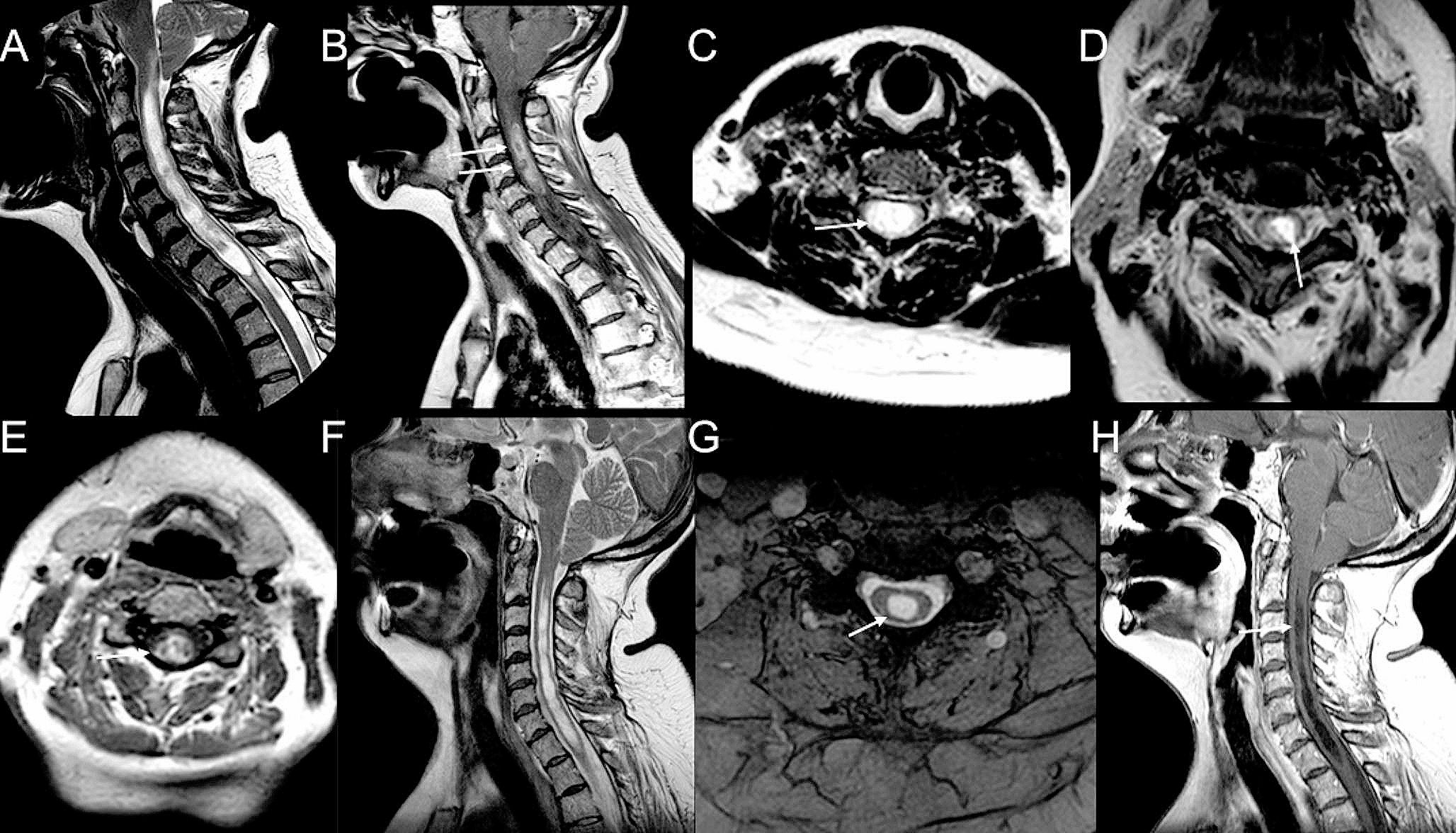 Neuromyelitis optica spectrum disorder-associated myelitis mimicking intramedullary neoplasm as a diagnostic pitfall: a case report