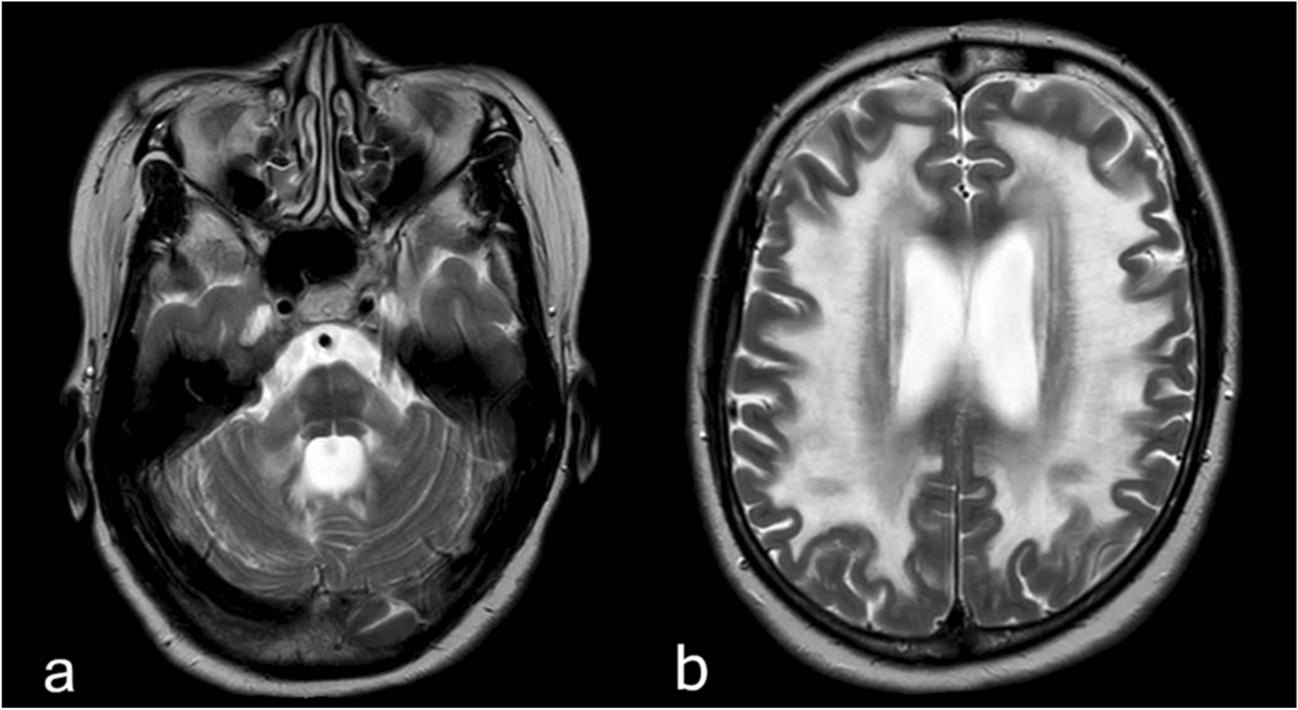 An early-onset case of adult-onset autosomal dominant leukodystrophy