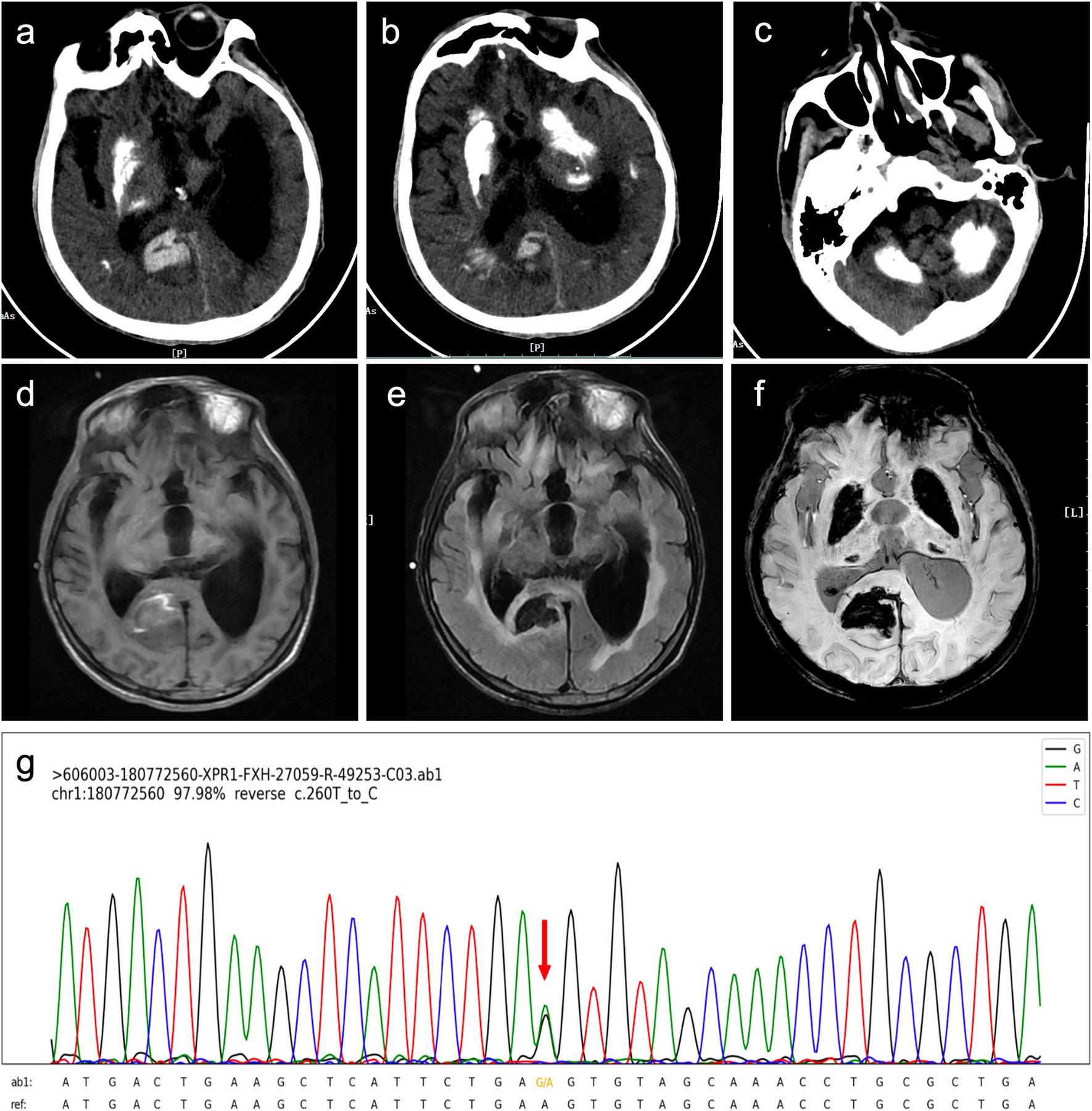 XPR1 mutation related Fahr’s disease presenting with a hemorrhagic stroke: a case report