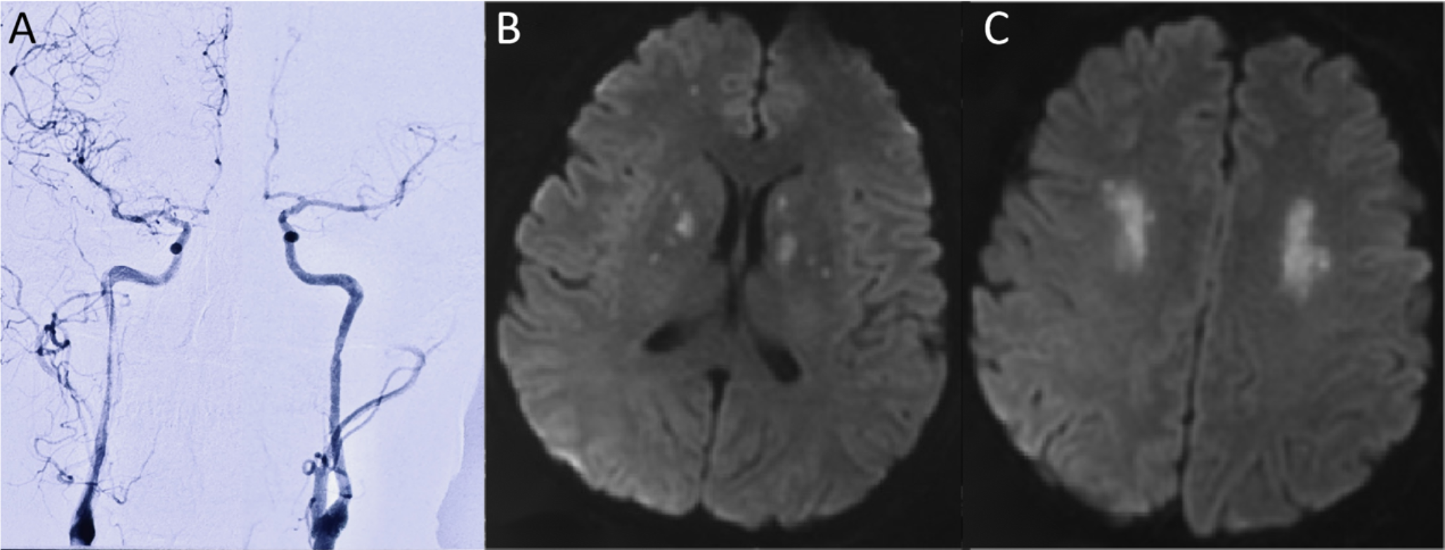 Reversible cerebral vasoconstriction syndrome and bilateral Eagle Syndrome cause recurrent reversible carotid artery stenosis and cerebral infarction