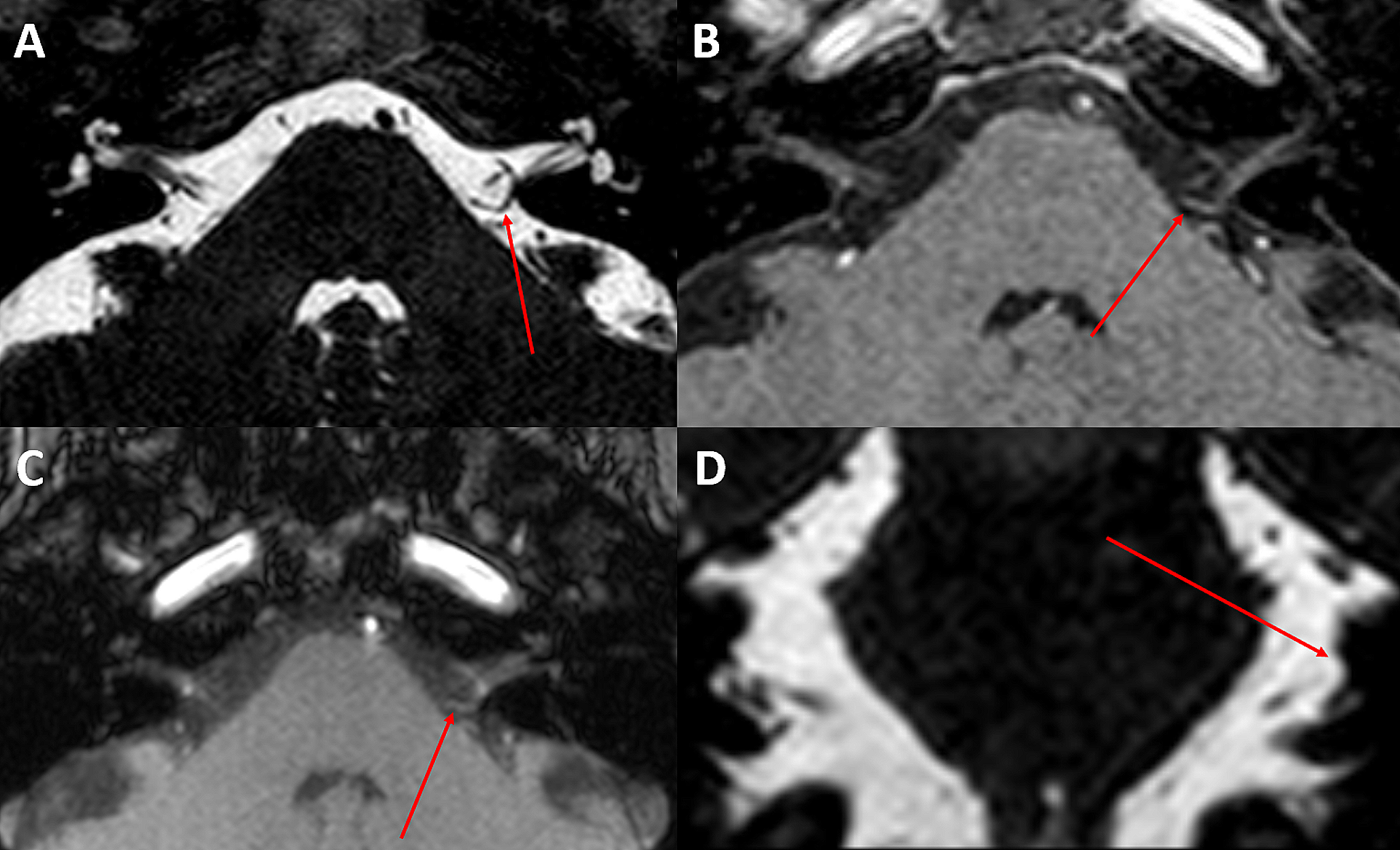 Radiological and intraoperative findings of a rare case of vestibular paroxysmia