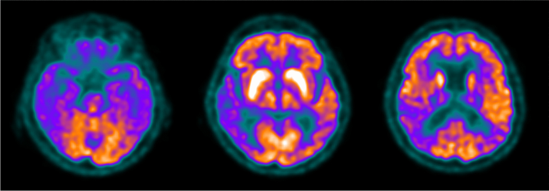 A case of hemichorea/hemiballismus in a patient with Alzheimer’s disease and history of Sydenham’s chorea: the return of an old acquaintance?