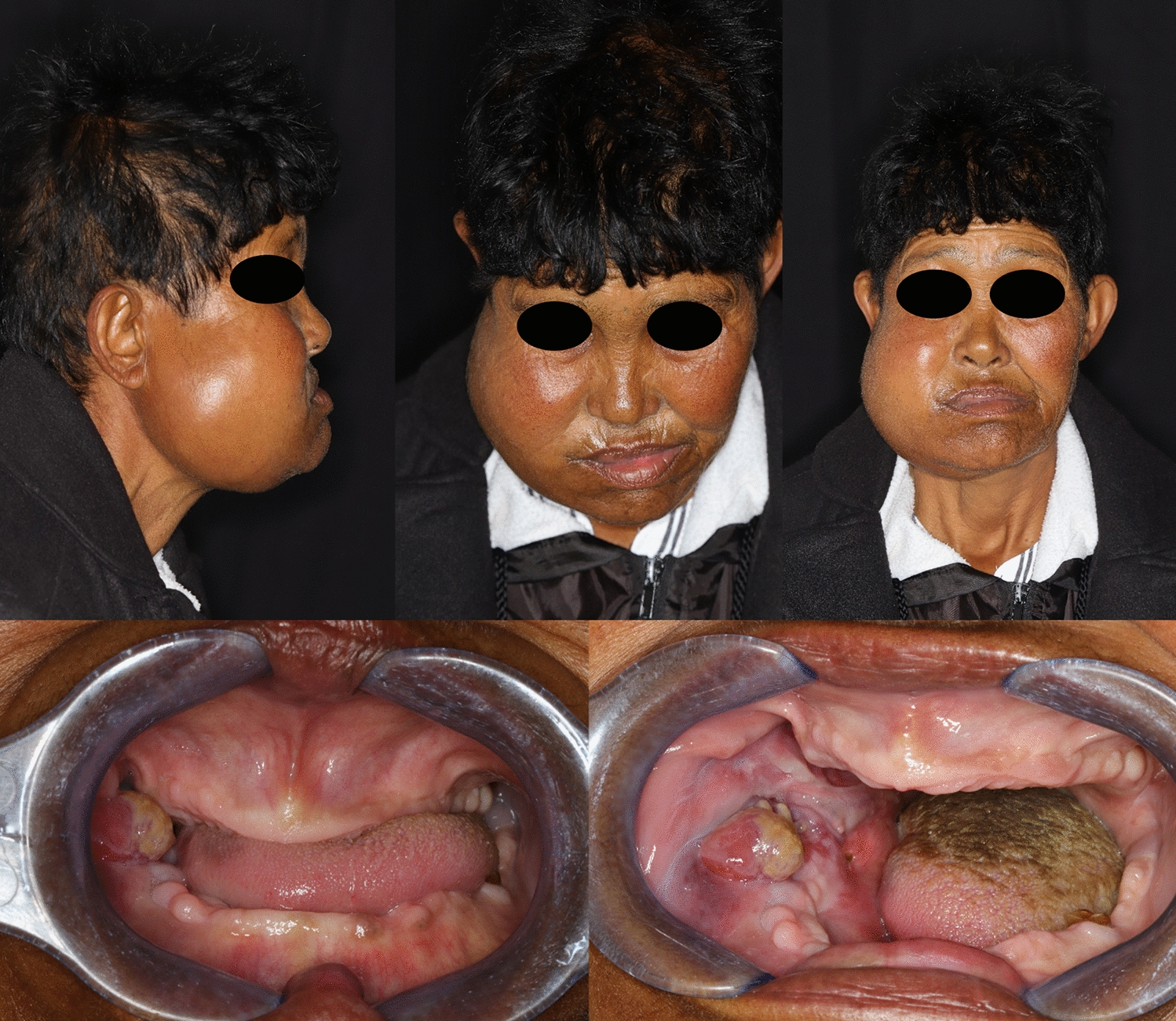 Osteosarcoma associated with cemento-osseous dysplasia: co-incidence or two related entities?