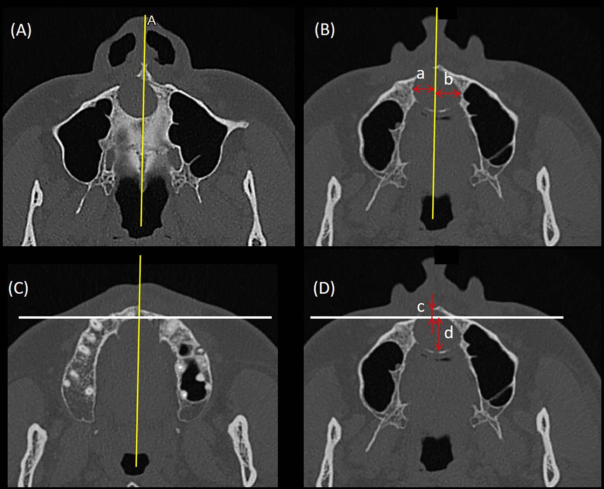 Spread asymmetry to differentiate nasopalatine duct cysts from radicular cysts arising in the anterior maxilla on computed tomographic images