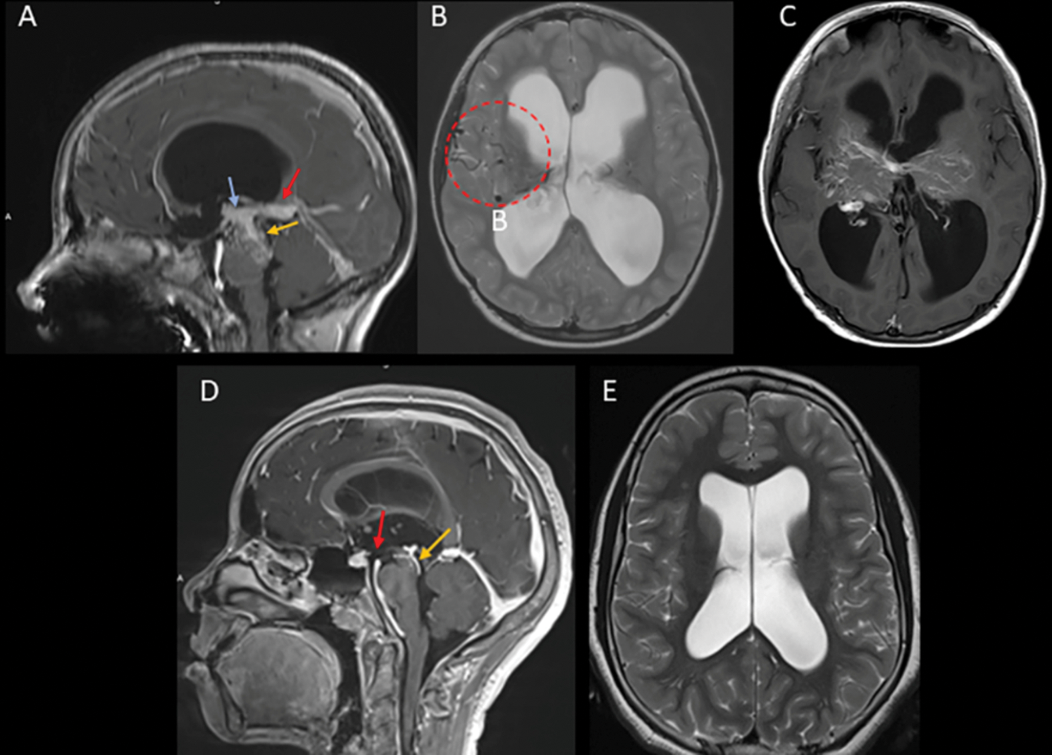 Obstructive hydrocephalus due to developmental venous anomalies: a pediatric imaging case series