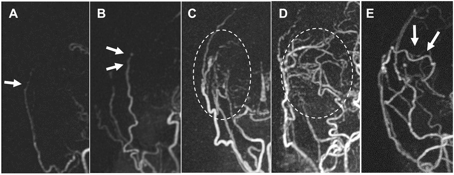 Visualization of cortical neoangiogenesis after combined revascularization surgery in moyamoya disease using silent MRA