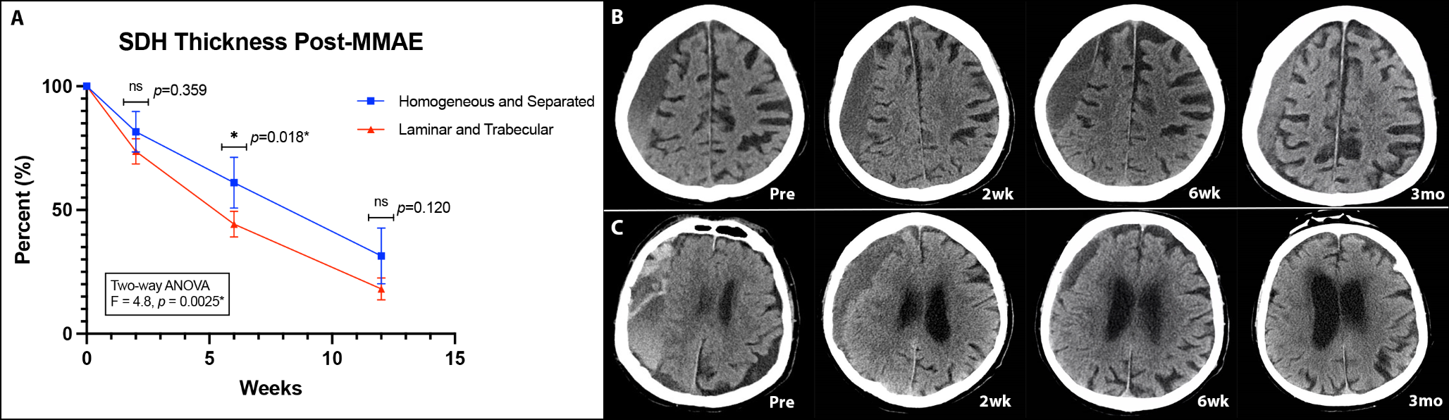 Internal hematoma architecture predicts subdural hematoma responsiveness to standalone middle meningeal artery embolization