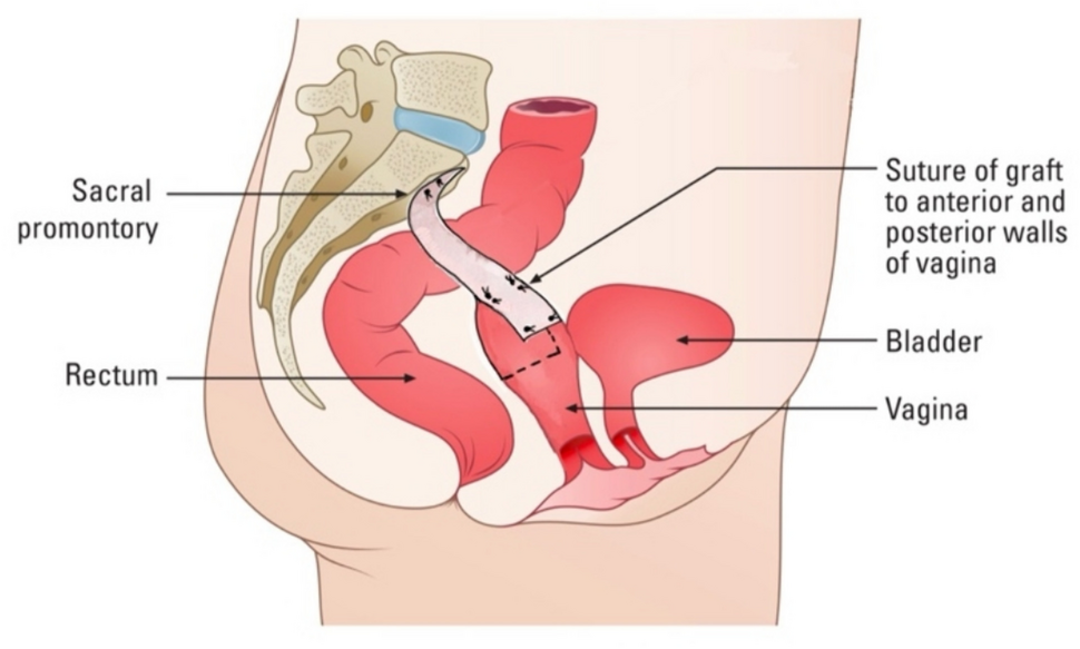 Sacrocolpopexy: Alternatives to Mesh Grafts