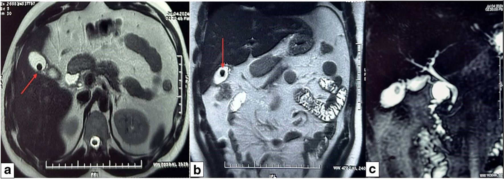 Mucinous Cystic Neoplasm of Gall Bladder Lacking the Usual Ovarian-Like Mesenchymal Stroma
