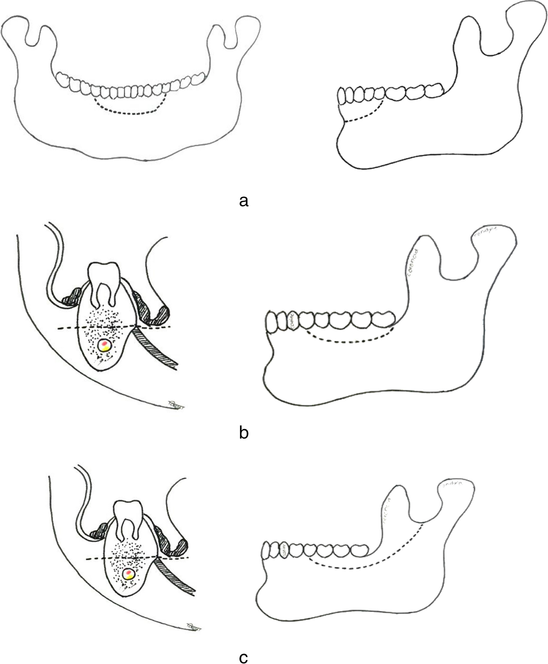 Marginal Mandibulectomy in Oral Cavity Cancers — Classification and Indications