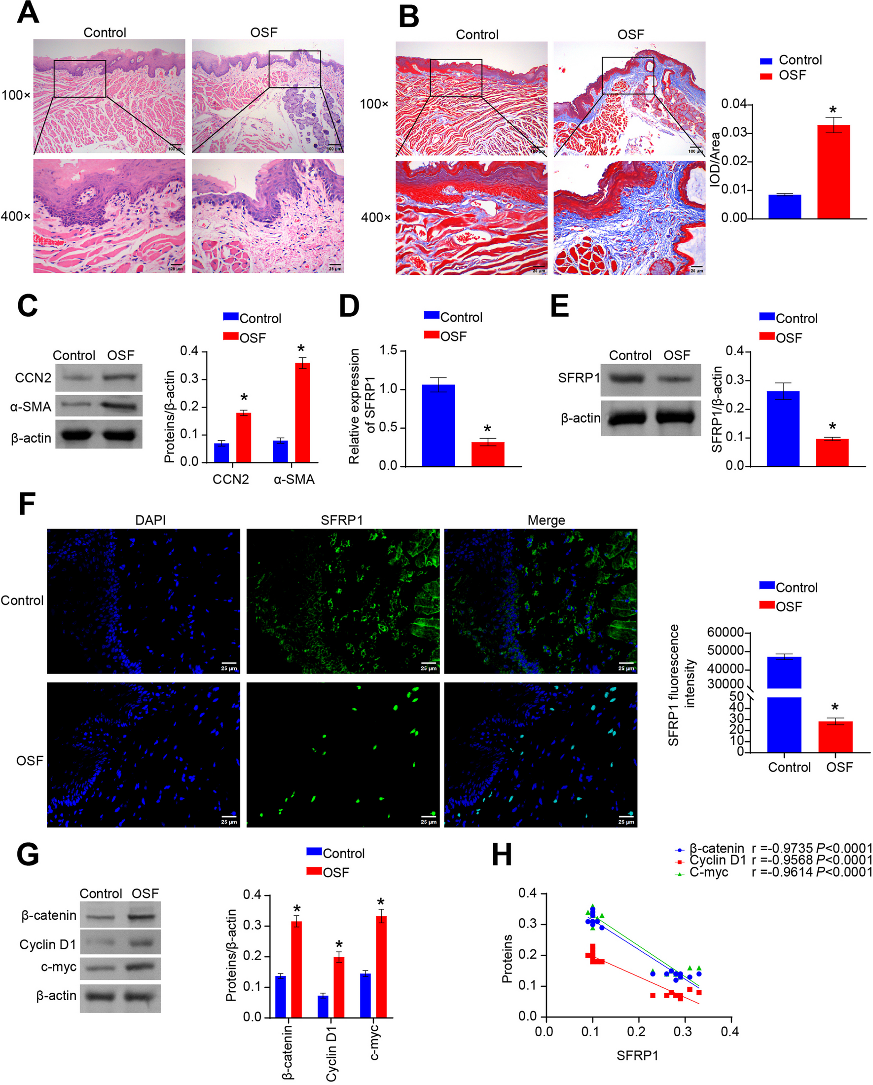SFRP1 reduces neutrophil infiltration and inhibits the Wnt/β-catenin pathway to alleviate oral submucous fibrosis