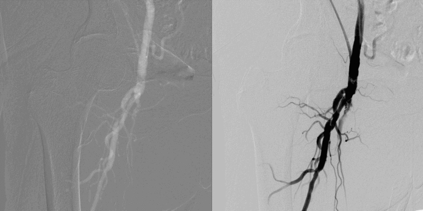 Parameter optimisation for image acquisition and stacking in carbon dioxide digital subtraction angiography