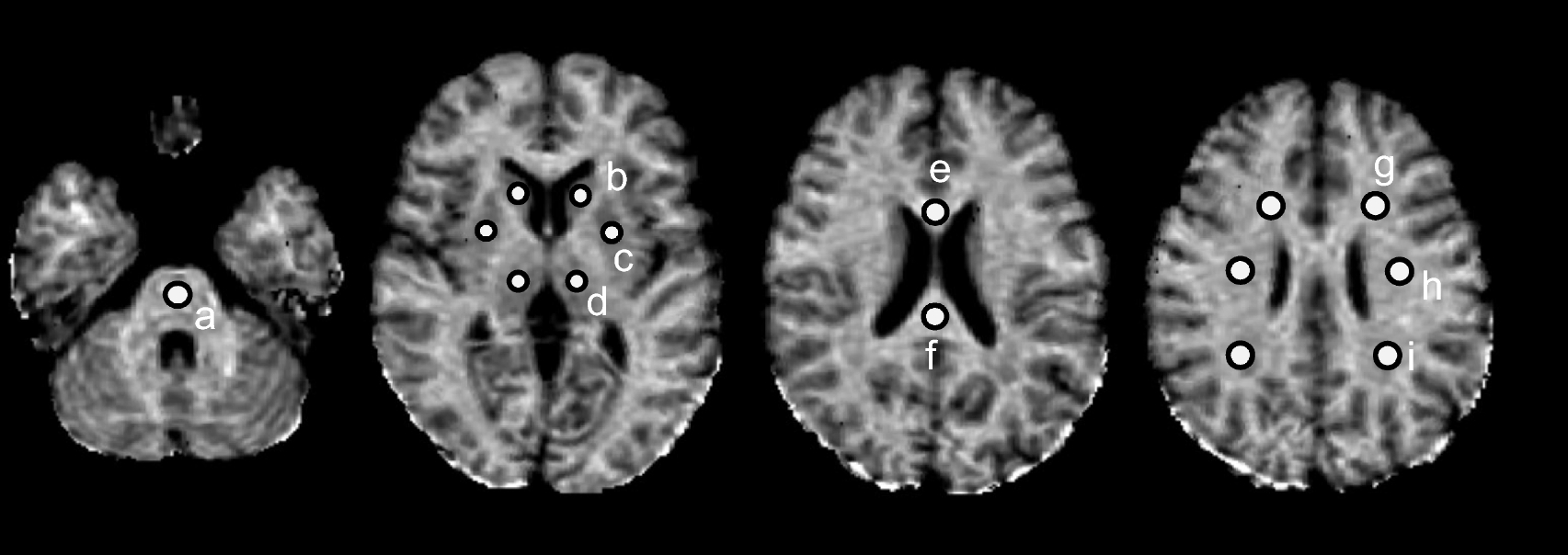Single-point macromolecular proton fraction mapping using a 0.3 T permanent magnet MRI system: phantom and healthy volunteer study