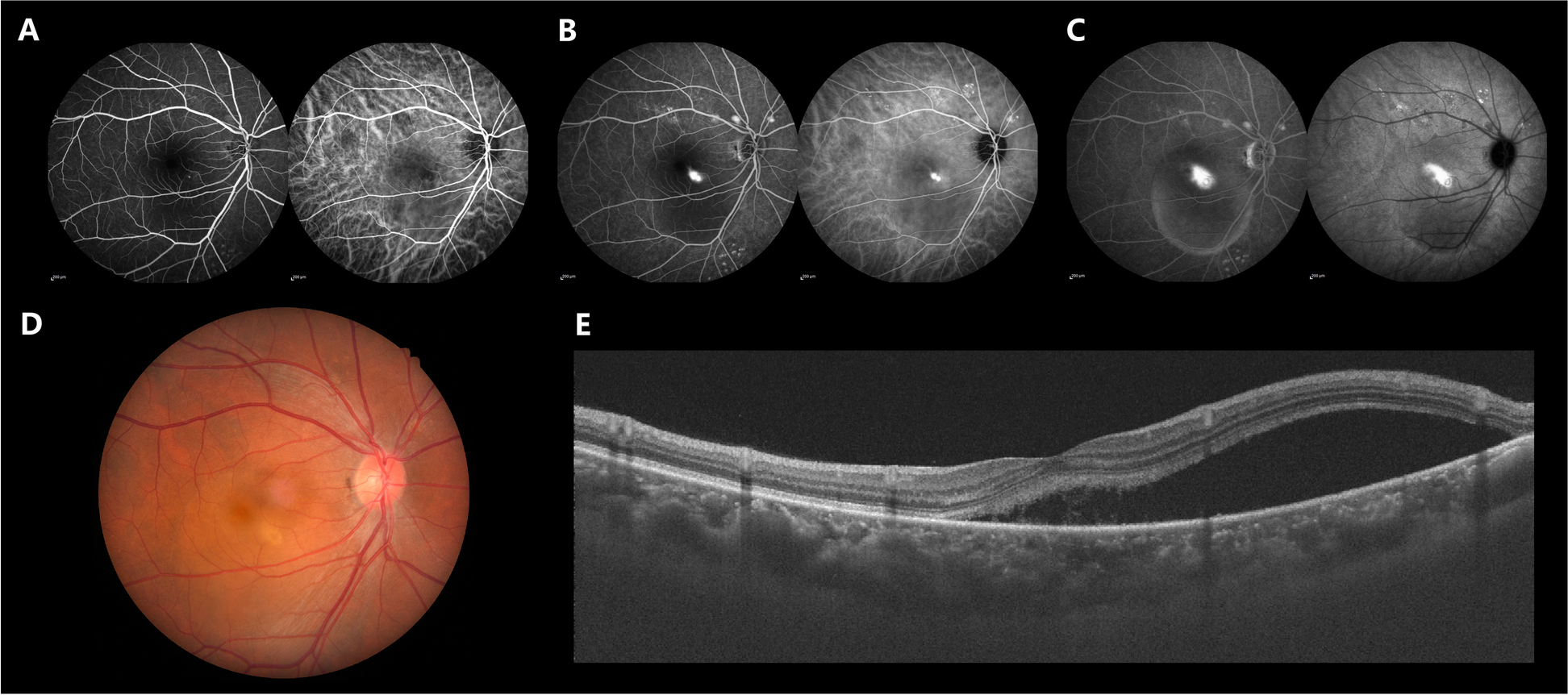 A clinical study on the therapeutic effects of 577 nm micropulse laser photocoagulation treatment in early-stage CSCR patients