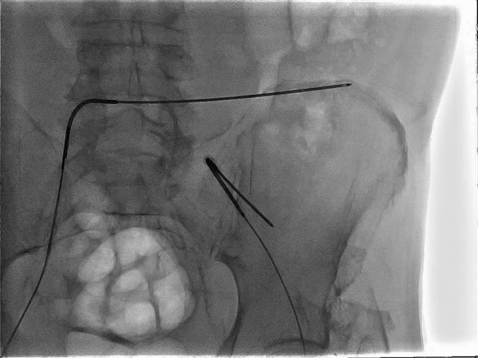Resolution of Severe Low Back and Gluteal Pain Following Superior and Medial Cluneal Nerve Cryoneurolysis