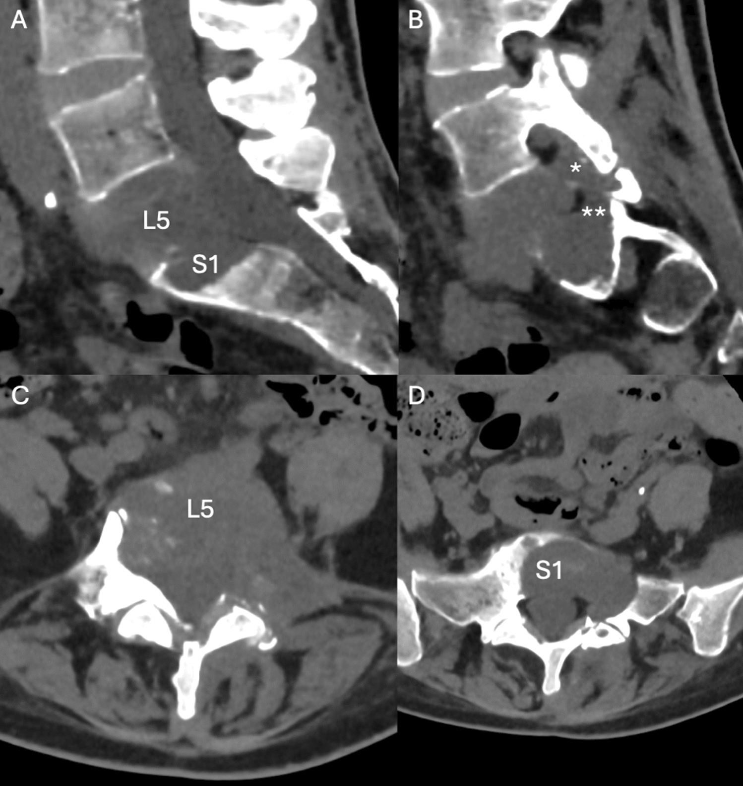 Percutaneous Management of an Unstable Pathological Fracture of L5 Using Vertical Presacral Screw Fixation and Cementoplasty