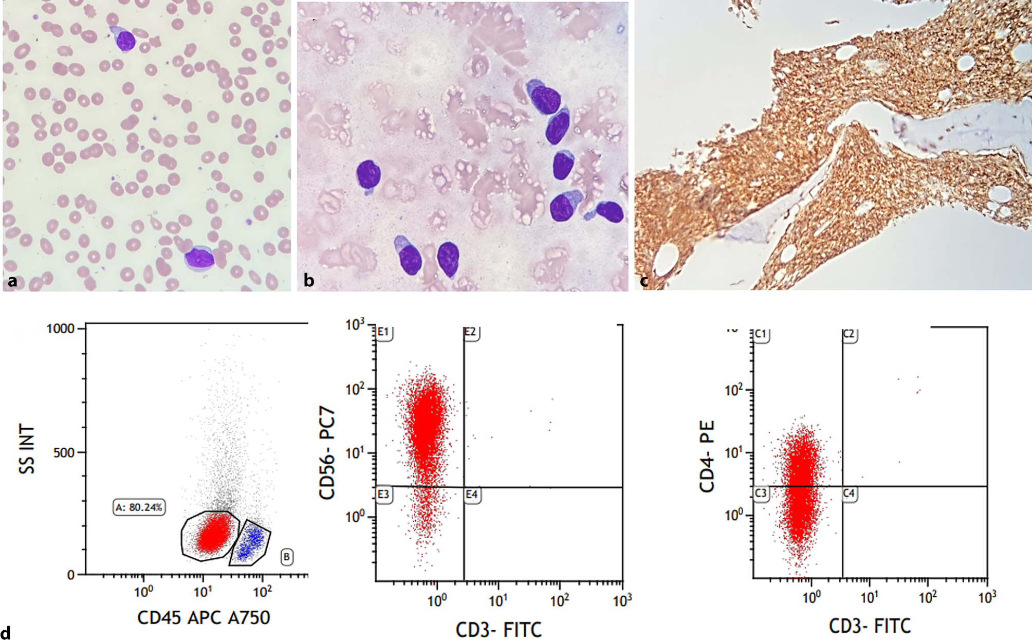 Unclassifiable acute leukemia with blastic plasmacytoid dendritic cell neoplasm: deciding on the appropriate therapy