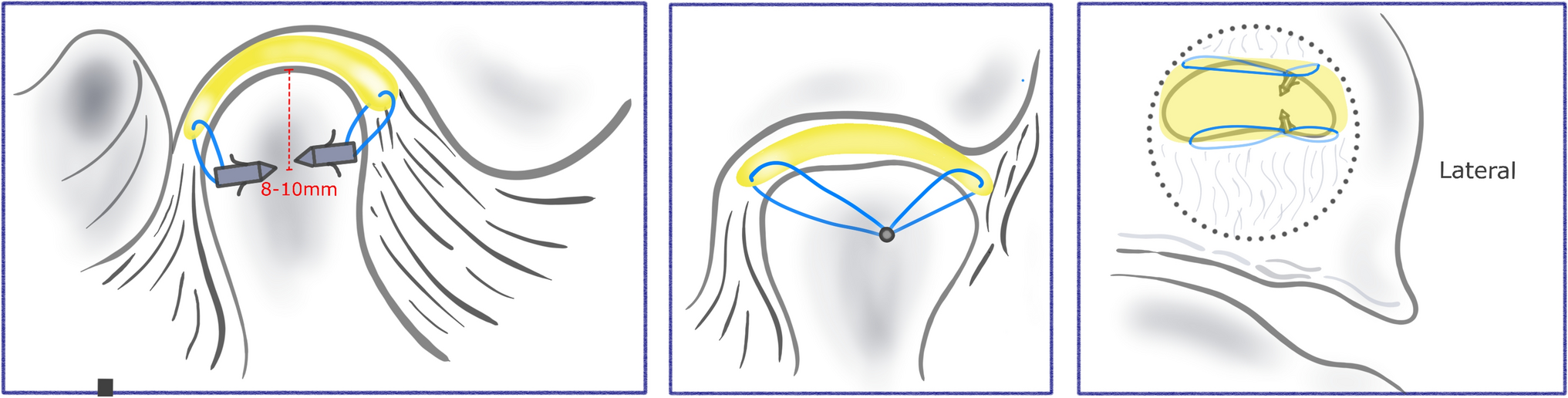Temporomandibular Joint Disc Replacement with Acellular Dermal Matrix for Irreparable Disc