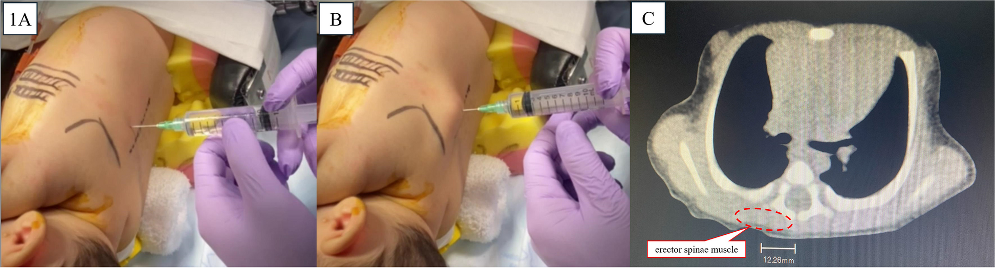 Anatomical landmark-guided compartment block in pediatric lateral thoracotomy: implications for the vertebral arch surface