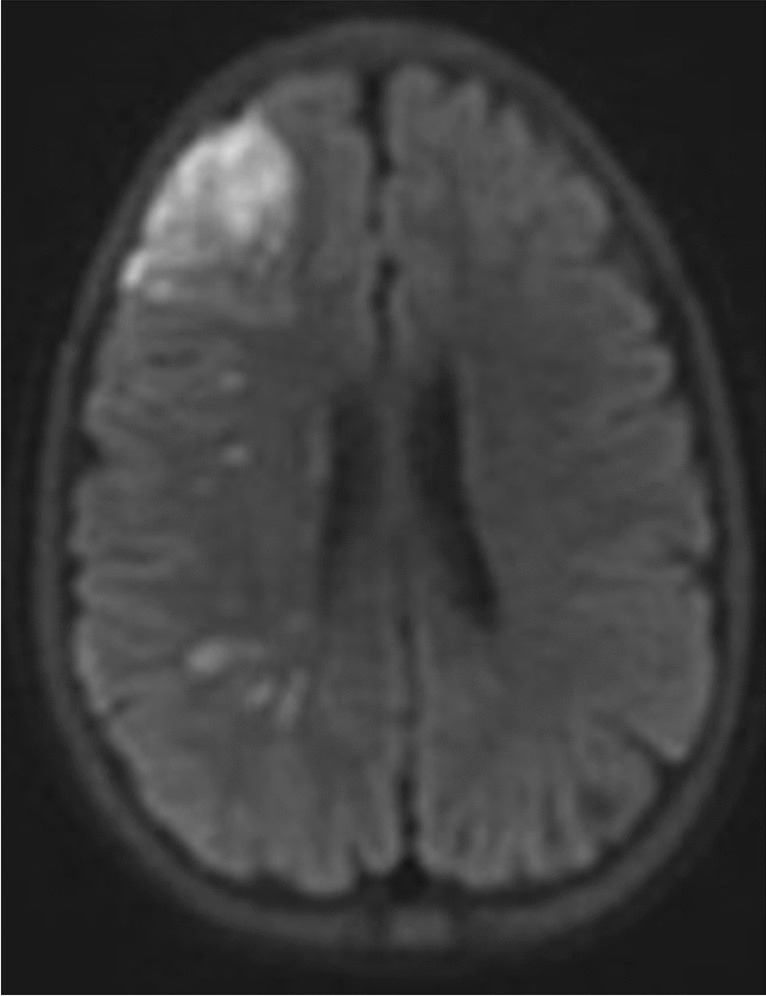 Stroke Prevention and Treatment for Youth with Sickle Cell Anemia: Current Practice and Challenges and Promises for the Future