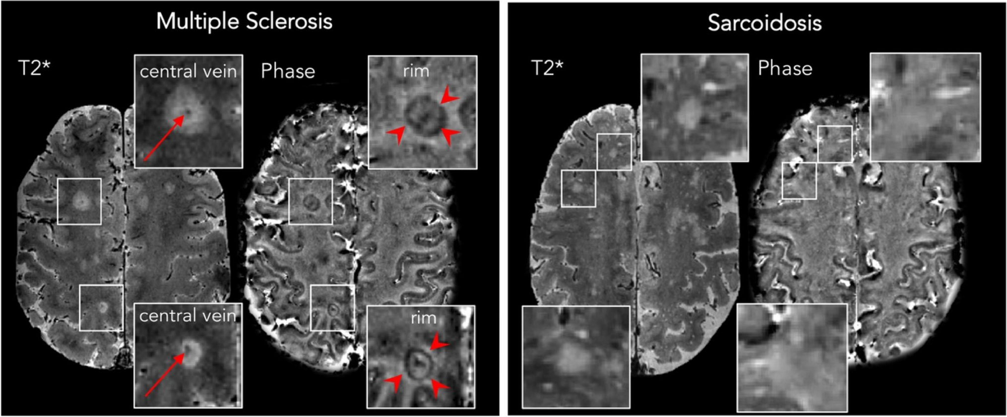 Misdiagnosis of Multiple Sclerosis: Past, Present, and Future