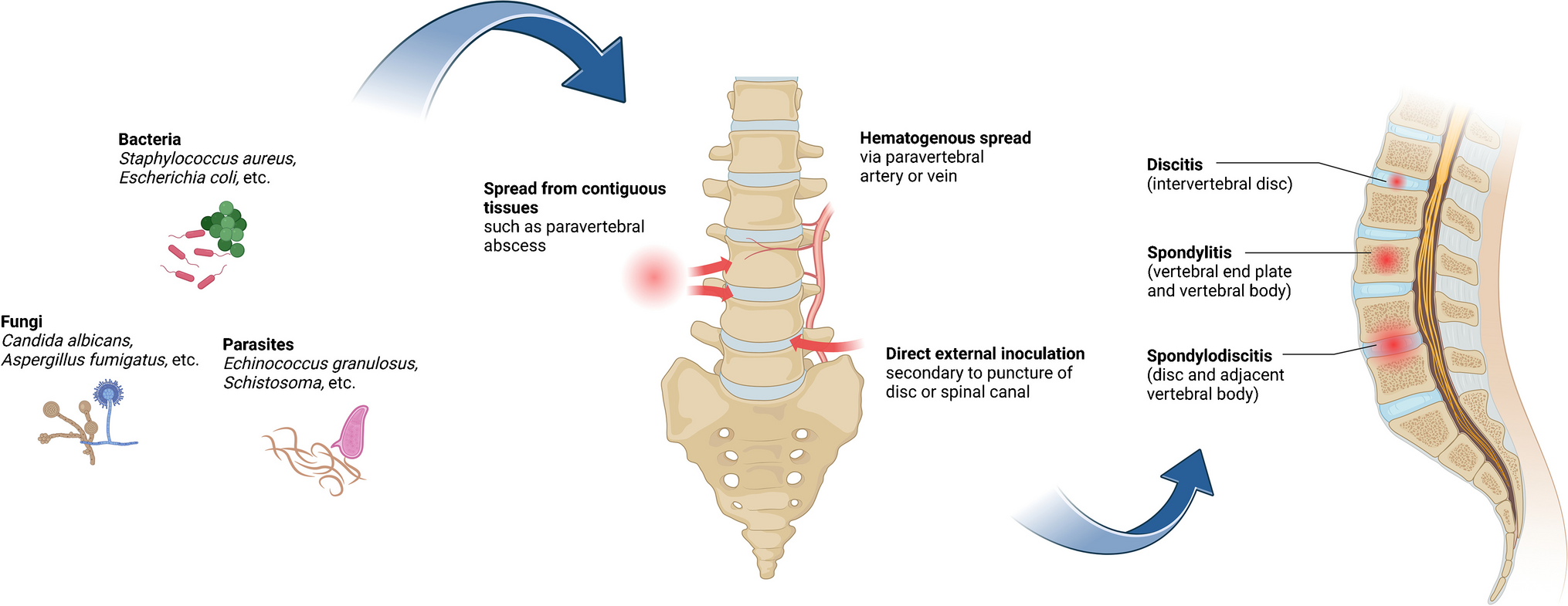 Current knowledge of vertebral osteomyelitis: a review