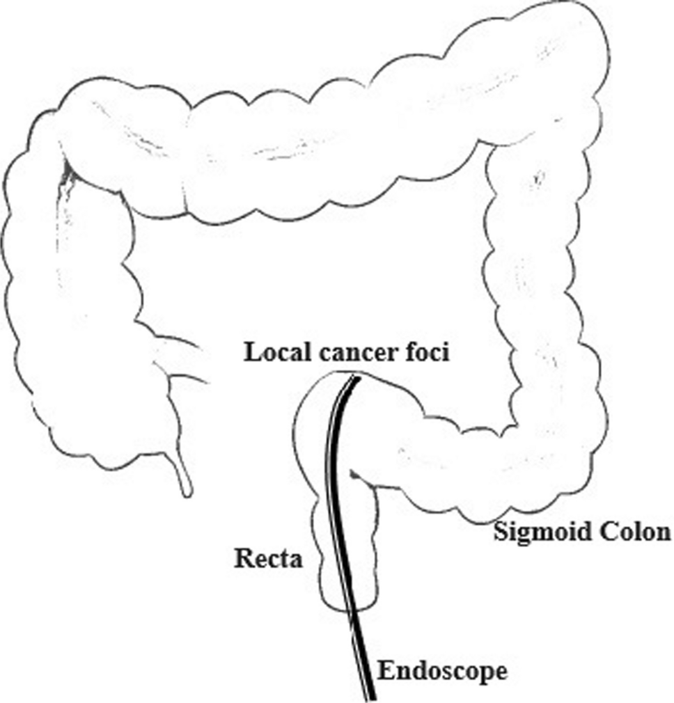 Endoscopic Resection of Stage T1 Colorectal Adenocarcinoma Followed by Surgical Intervention: a Single-center Retrospective Study